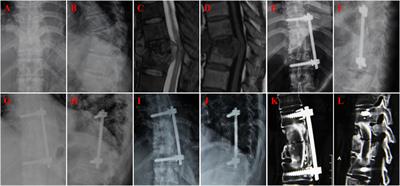 A comparison of anterior reconstruction of spinal defect using nano-hydroxyapatite/polyamide 66 cage and autologous iliac bone for thoracolumbar tuberculosis: a stepwise propensity score matching analysis